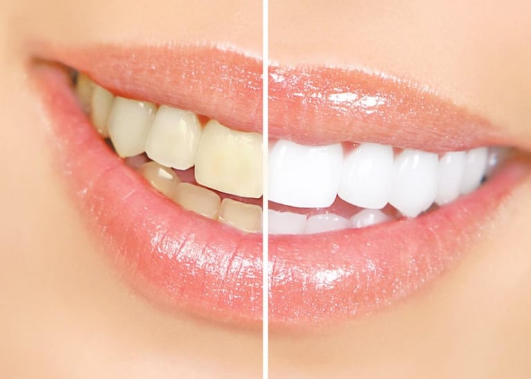 Los dientes amarillentos tienen múltiples causas.