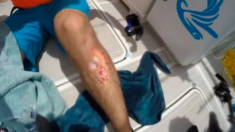 Los dientes del tiburón le abrieron una profunda herida en la pierna al pescador.