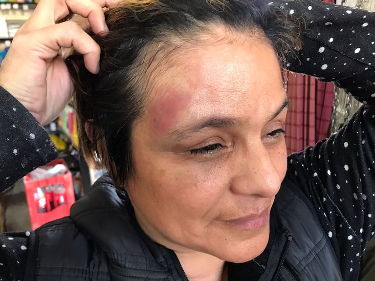 Los ladrones golpearon a la mujer en la cabeza.