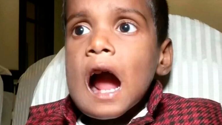 Más que una hinchazón: Ravindrath tenía 526 dientes de más.