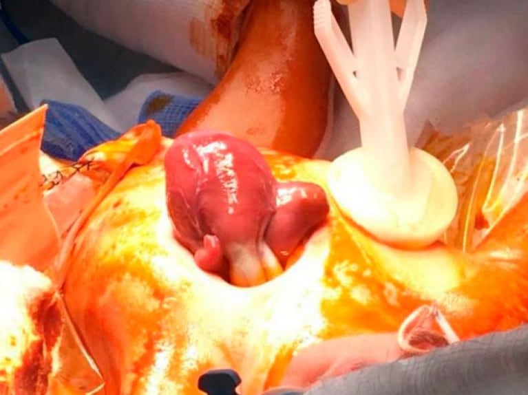 Milagro de la vida: una beba nació con el corazón afuera del cuerpo