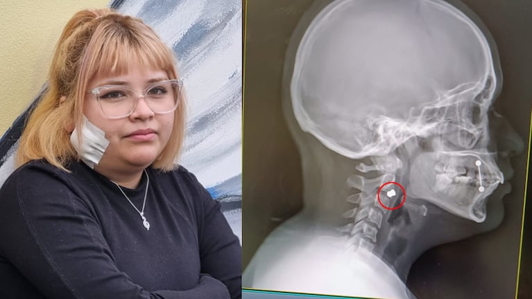 Milagros recibió un balinazo en la cara.