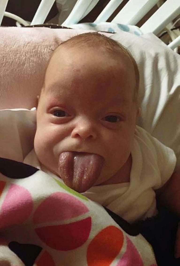 Operaron a la beba que nació con la lengua de un adulto