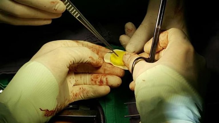 Operaron a un nene usando un corazón 3D y ya recibió el alta