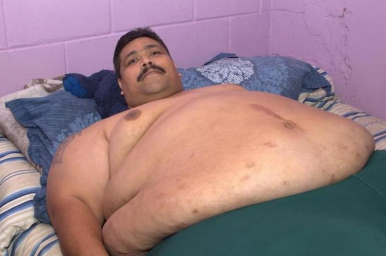 Operaron al hombre más obeso del mundo