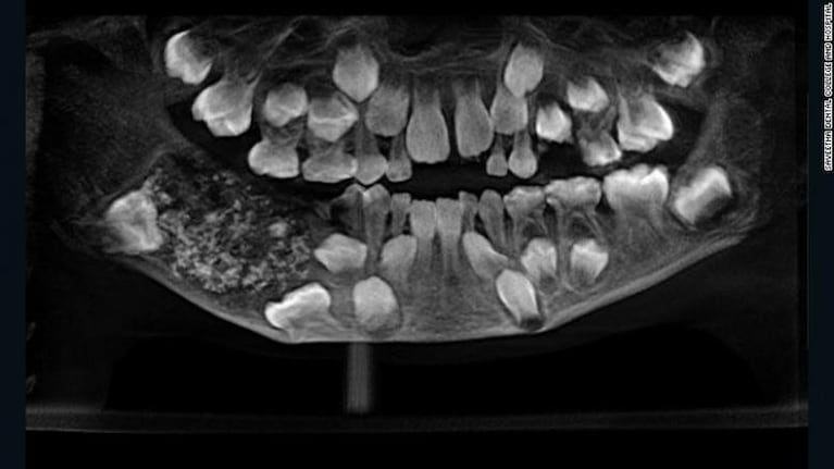 Pensaron que era un dolor de muela... Tenía más de 500 dientes