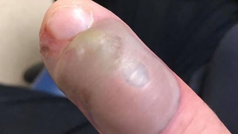 Por comerse las uñas, se infectó un dedo y casi pierde un brazo