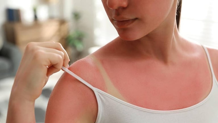 Preocupa la moda de el "callo solar"