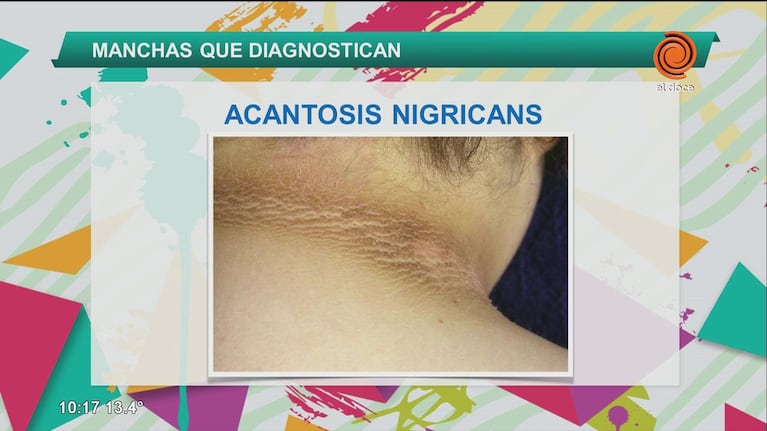 Qué es la Acantosis nigricans