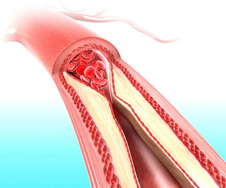 ¿Qué es la rigidez arterial y cómo afecta a tu salud?