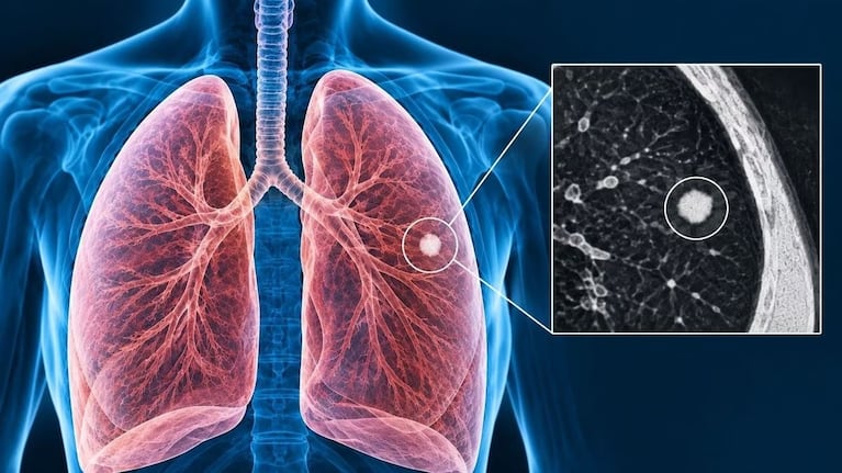 Qué es un nódulo pulmonar y cuánto tardaría la recuperación del papa León XIV