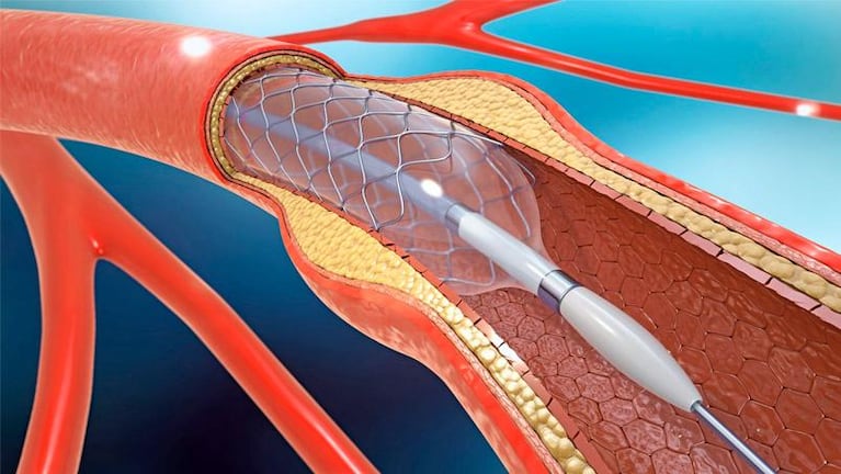 Qué es una angioplastia, la intervención que le realizaron a Llaryora