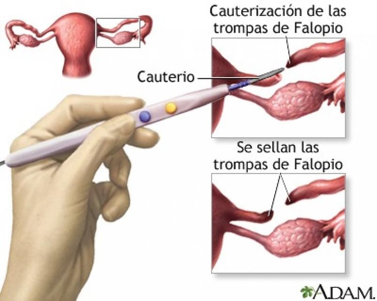 Qué implica ligarse las trompas: riesgos y reversibilidad del método