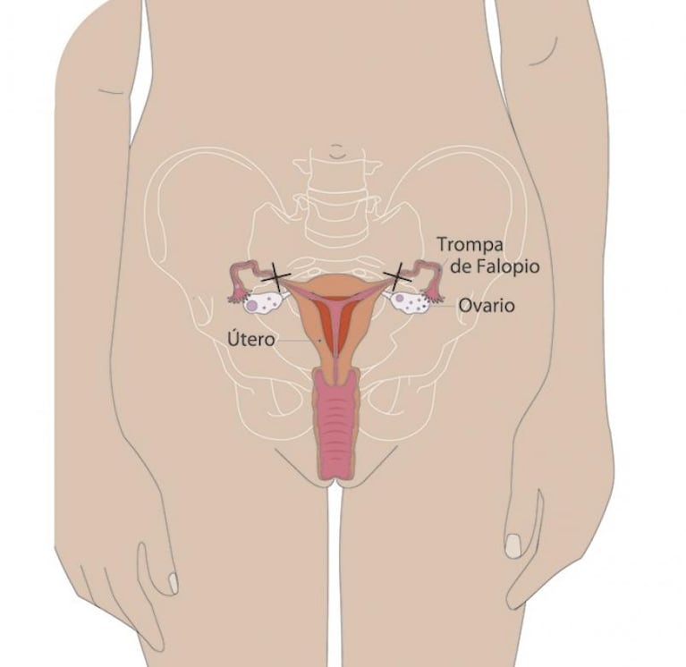 Qué implica ligarse las trompas: riesgos y reversibilidad del método