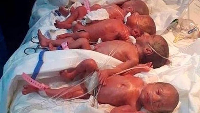 Récord mundial: una mujer esperaba septillizos y dio a luz a nueve bebés