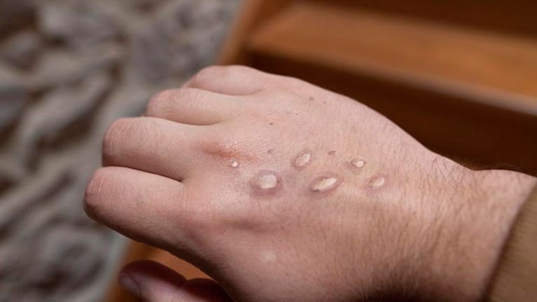 Registraron el primer caso de la variante más agresiva de viruela del mono en la Argentina. 