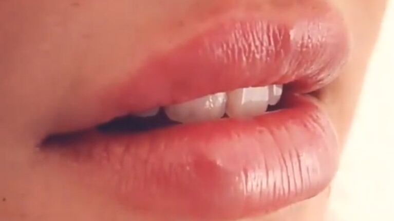 Relleno con ácido hialurónico para labios más sensuales y carnosos. (Foto: Instagram / dra.albernaz.barbara)