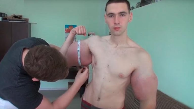 Riesgo de vida: podrían amputarle los brazos al Hulk ruso