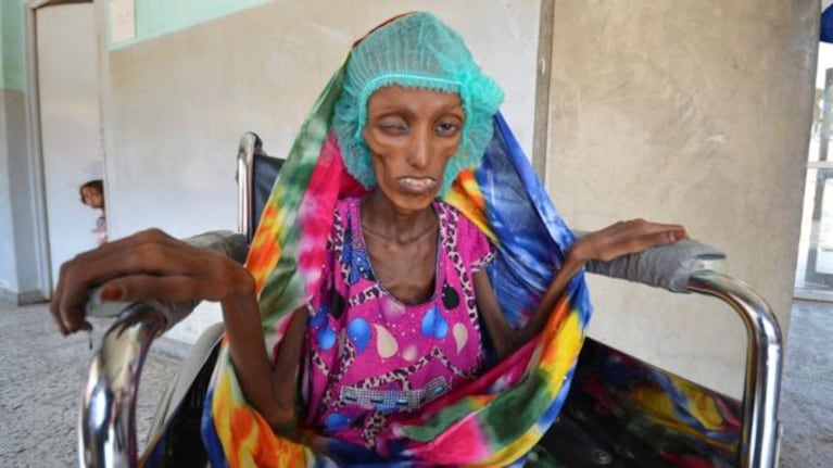 Saida intentó levantar la cabeza para la foto pese a su gravísima desnutrición. Foto: Reuters.