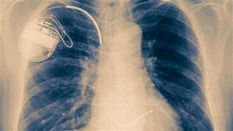 Se autoimplantó chips e imanes para que su cuerpo fuera mejor