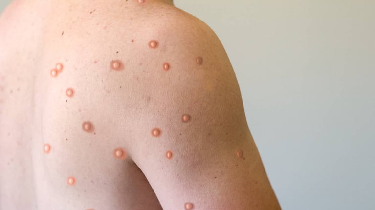 Se confirmó el priemer caso de la variante más agresiva de la viruela del mono. (Foto: Adobe Stock)