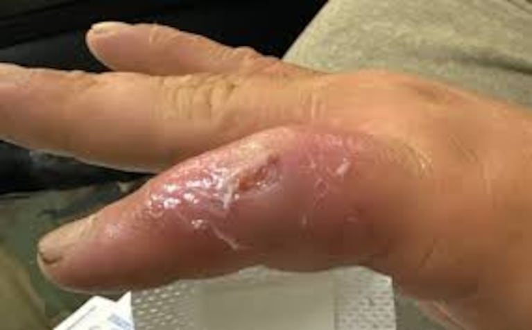 Se encontró un oso y contrajo una rarísima infección: podría ser el primer caso en el mundo