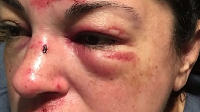 Se lesionó tras caer en un bache, demandó a la ciudad y ganó millones de dólares