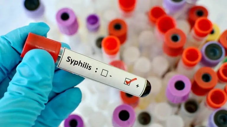 Se registró un aumento de casos de Sífilis en Argentina.