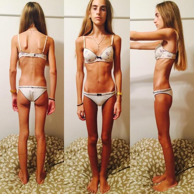 Sufrió anorexia, mostró las fotos del antes y después y conmovió a miles