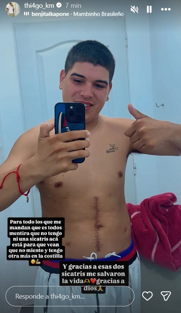 Thiago Medina mostró las cicatrices por el accidente en moto e impresionó a todos