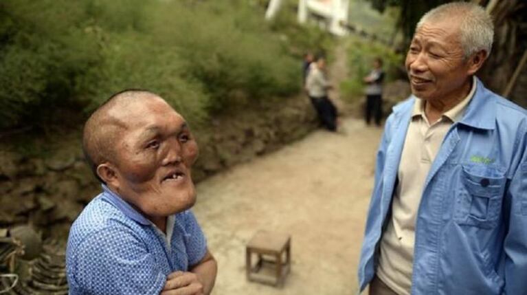 Un caso de hiperplasia facial sorprende a China