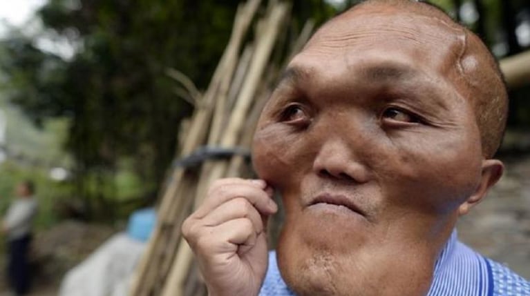 Un caso de hiperplasia facial sorprende a China