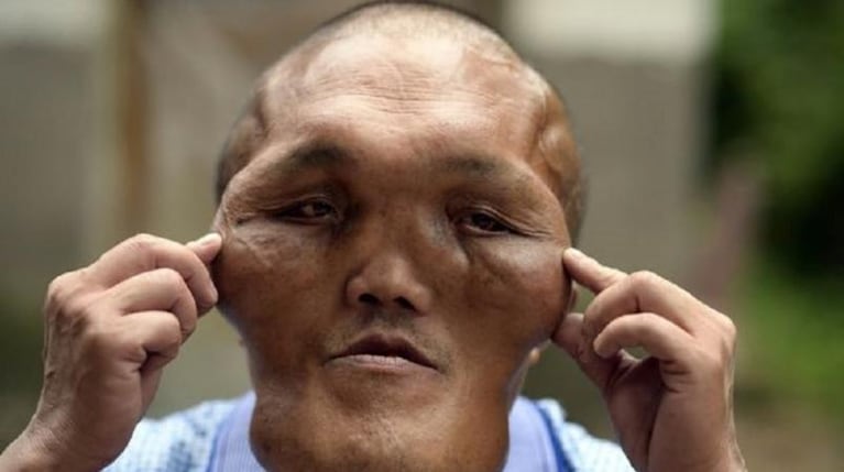 Un caso de hiperplasia facial sorprende a China