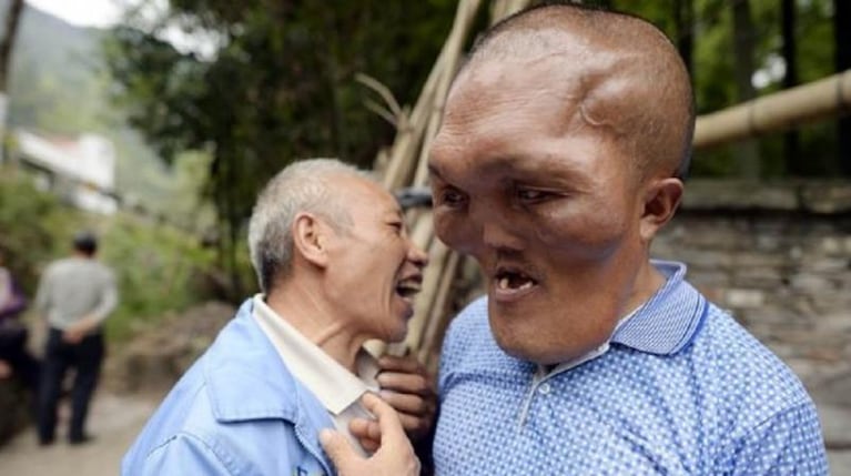 Un caso de hiperplasia facial sorprende a China