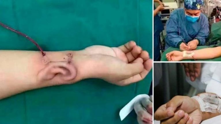 Un hombre perdió una oreja y se la cultivaron en el brazo