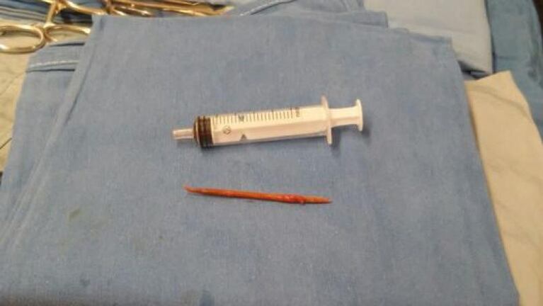 Un hombre se tragó un escarbadientes y se le fue al corazón