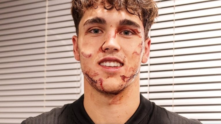 Un jugador del Barcelona terminó con 10 puntos por una patada en la cara: el video y la foto