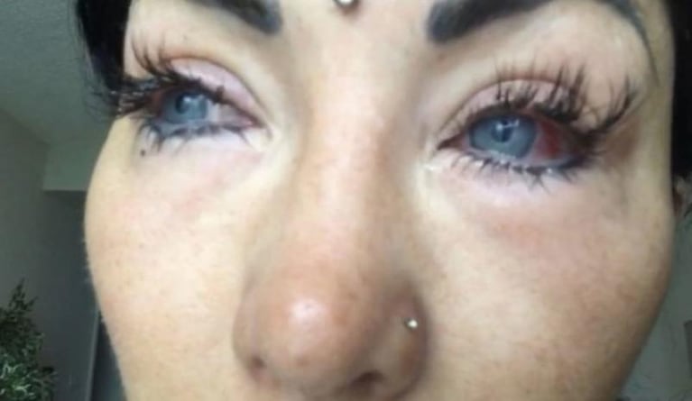Una argentina quedó casi ciega al cambiar el color de sus ojos