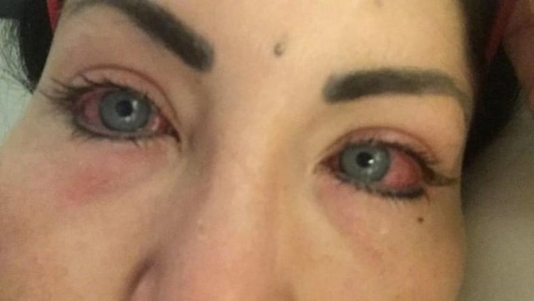 Una argentina quedó casi ciega al cambiar el color de sus ojos