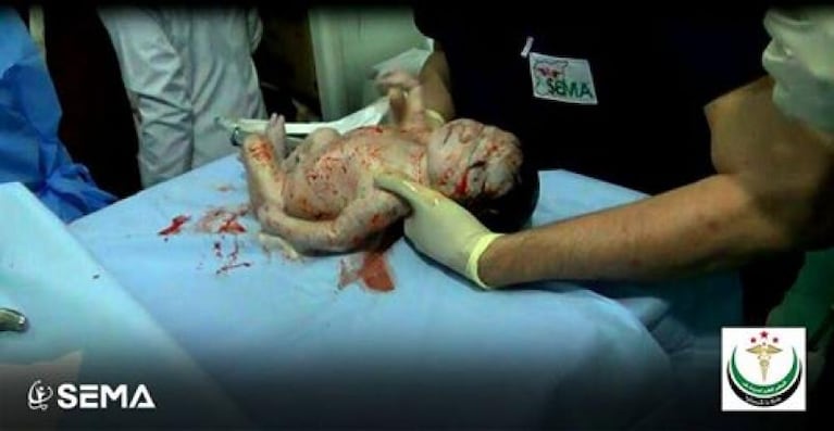 Una beba siria nació con una esquirla en la frente
