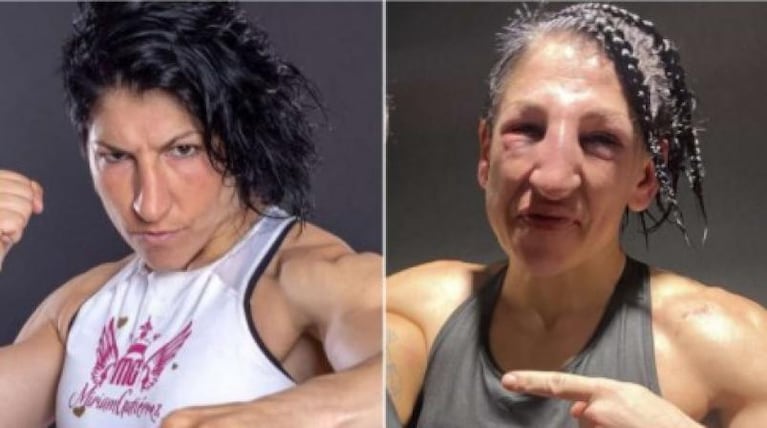 Una boxeadora recibió más de 236 golpes y su cara quedó desfigurada