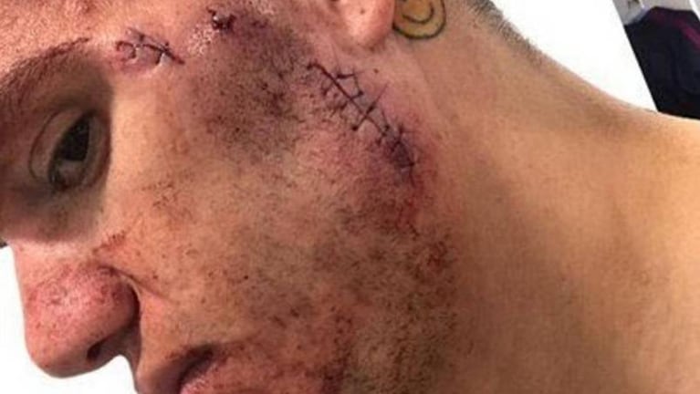 Una brutal patada desfiguró el rostro del arquero Ederson