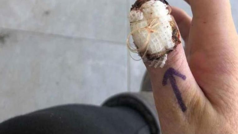 Una joven sufrió la amputación de su dedo por morderse las uñas