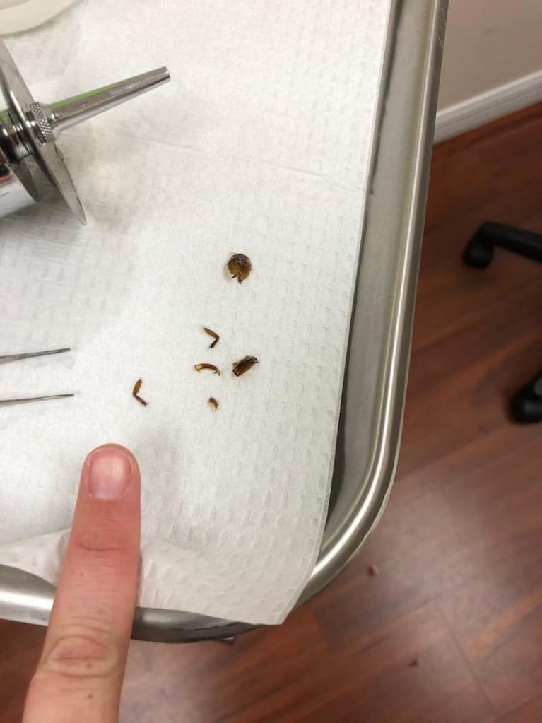 Una joven tuvo una cucaracha en su oído durante nueve días