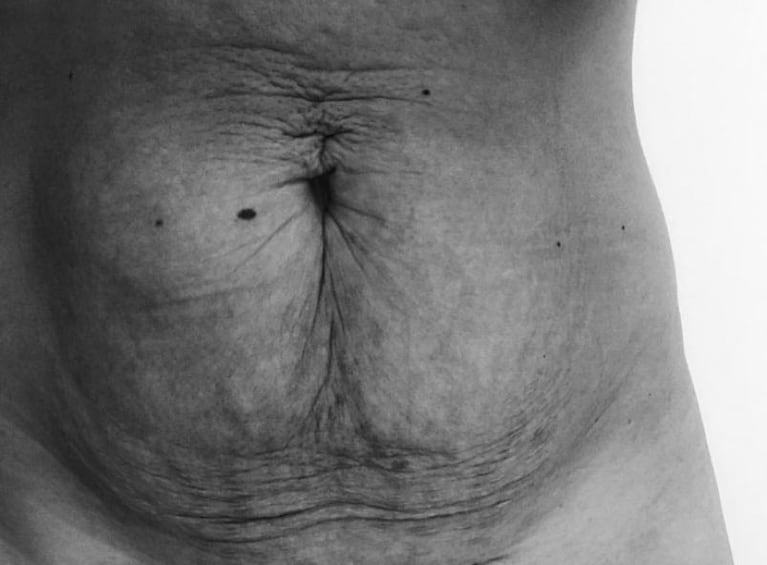 Una mamá mostró las cicatrices de su panza tras dar a luz