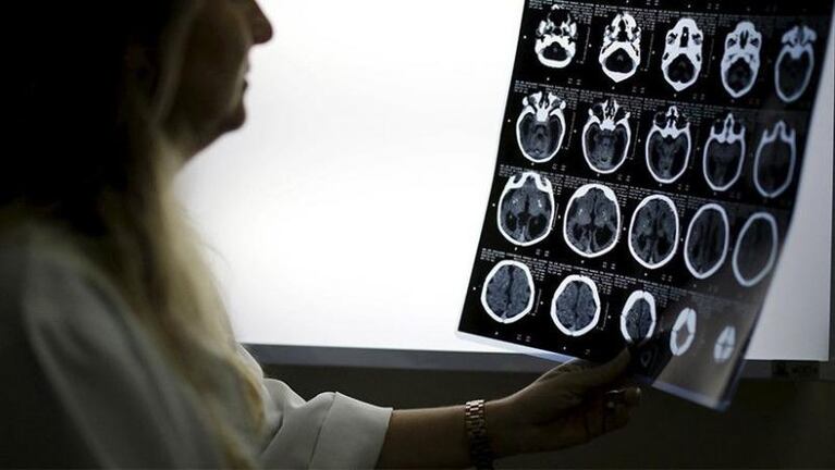 Una mujer creyó que estaba resfriada, pero estaba perdiendo el cerebro por la nariz