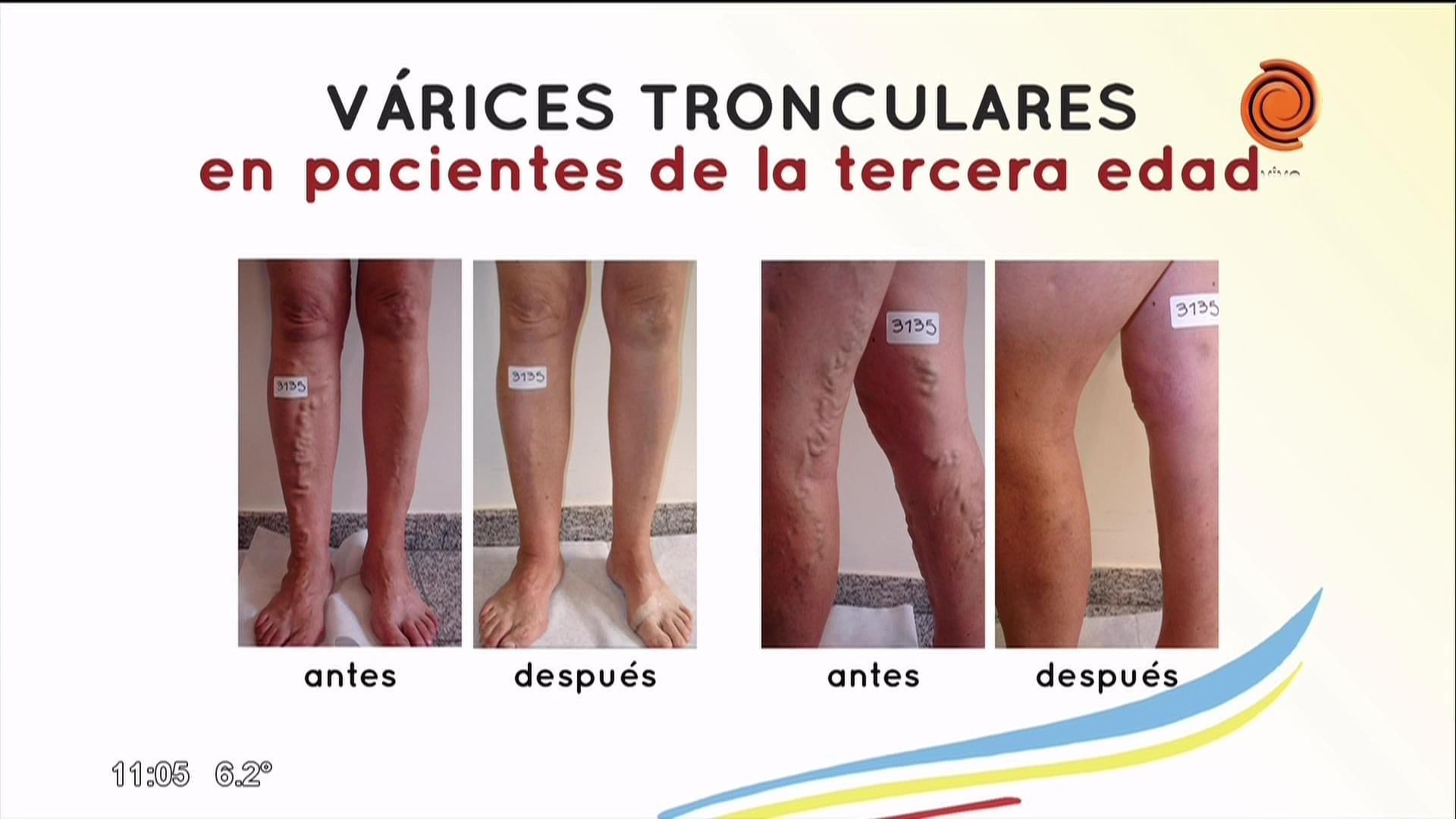 Várices tronculares en la tercera edad