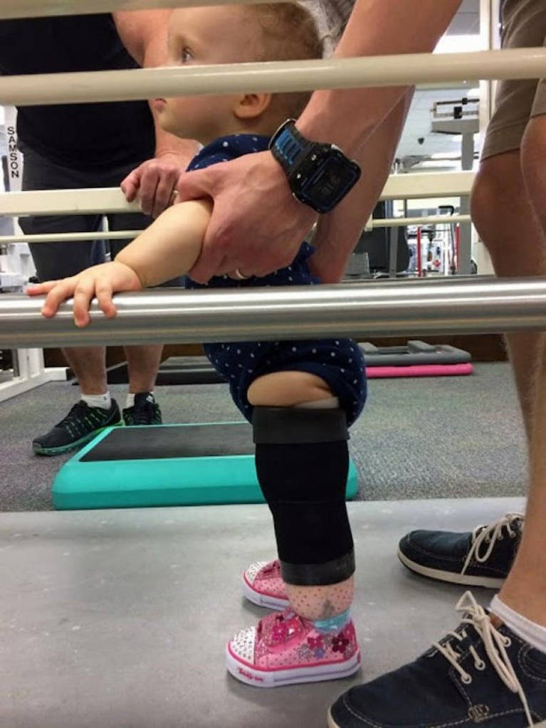 Video: tiene dos años y corrió por primera vez con una prótesis de pierna