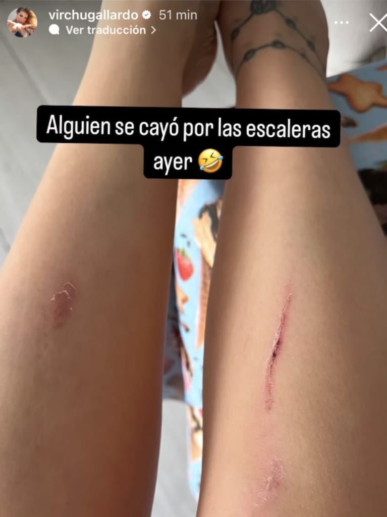 Virginia Gallardo sufrió un doloroso accidente y mostró cómo quedaron sus piernas