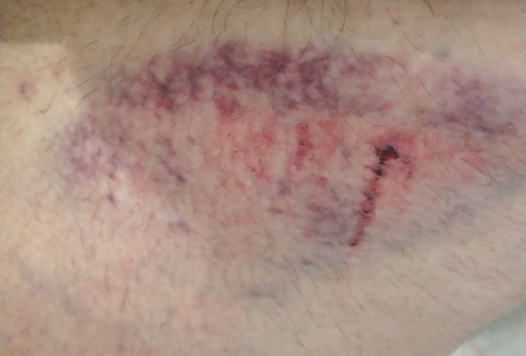 Volvía caminando de trabajar y la comió un socavón de 3 metros: “En un segundo el piso se fue”